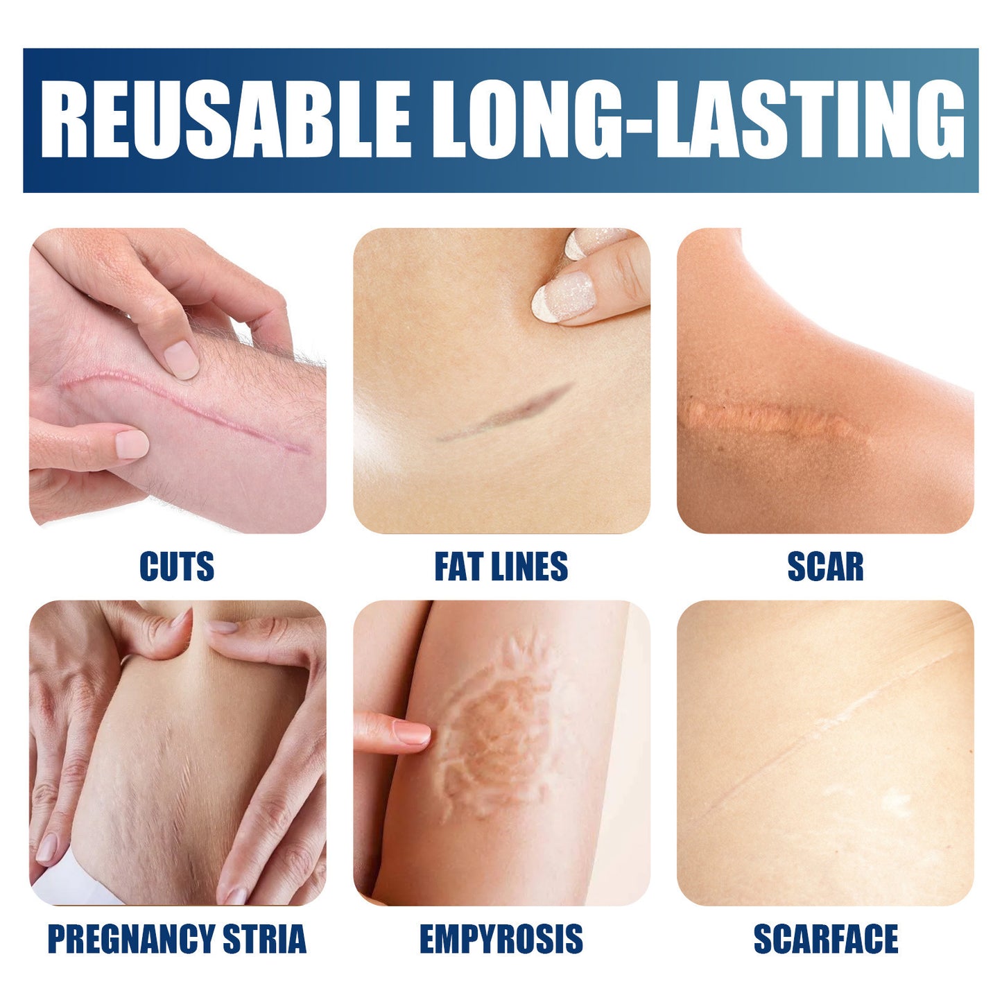 Scar Gel Scar Cream for Surgical Scars C-Section Stretch Marks Acne Injury Burns Keloids Hypertrophic For Old & New Scars